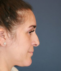 Feel Beautiful - Rhinoplasty Surgery - Before Photo